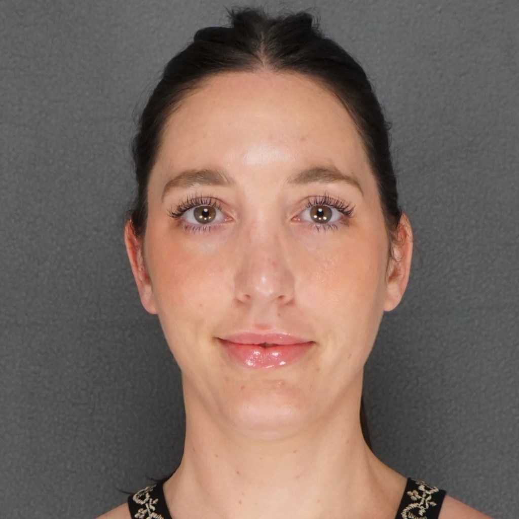 nose job, rhinoplasty, nasal dorsum, bump, nasal tip Customized Natural Beautiful Rhinoplasty – post op front brunette